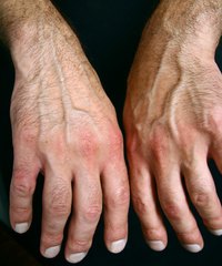 Paraffin therapy can help soothe aching hands and feet.