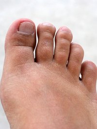 Nail-bed fungus starts slow and gradually makes nails brittle, weak and discolored.