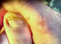 Infections Show Up as Diseased Areas in the Body