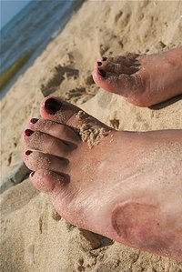 Melanoma may start as skin discoloration and progress to cause fatigue.