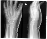 A bone scan detects abnormalities in bone.