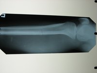 Bone marrow disfunction