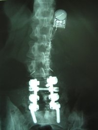 Spinal fusion is performed to improve functional abilities.