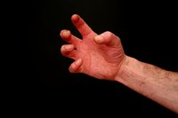 Cracked or splitting fingernails affect nearly 20 percent of people.