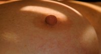 Breast Lump Under The Nipple