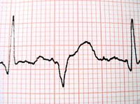 An EKG trace can be used to calculate heart rate.
