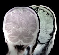 Image of the brain