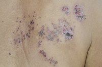 Shingles can be debilitating but rarely qualifies you for SSI disability.