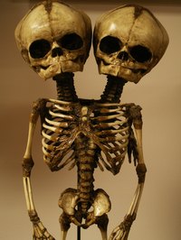 Conjoined twins are genetically identical, so they are always the same gender.