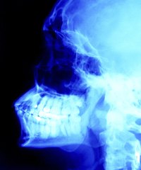 In an underbite lower teeth protrude over the top teeth.