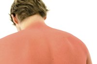 A man with a severe sunburn.