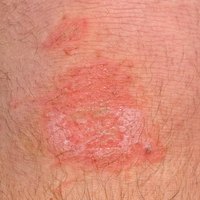 A skin lesion on an adult male's leg