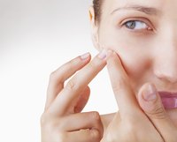 Make sure not to pop a whitehead because it can lead to scarring.