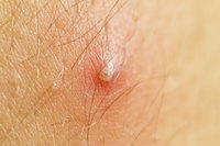 Boils are usually caused by Staphylococcus bacteria.