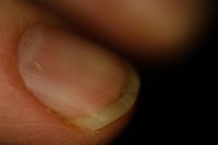 Split fingernails can be the result of injury or brittle nails.