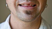 What Makes Adults Lose Their Teeth? What Makes Adults Lose Their Teeth?