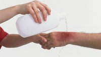 Burn Injury to the Hands Burn Injury to the Hands