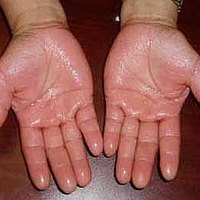 sweaty hands cure