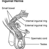 What causes testicular hernia pain?