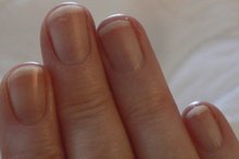 How to Treat Fingernail Fungus