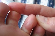 How to Heal Blisters that Have Opened