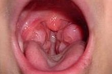 How to Cure Cryptic Tonsils