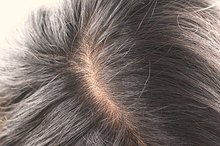 How to Treat Hair Loss by Strengthening Your Kidneys