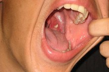 How to Clean Cryptic Tonsils