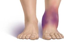 How to Reduce Swelling with Home Remedies