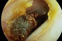 What Causes Ear Wax Build Up?