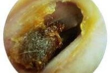 Causes of Calcified Ear Wax