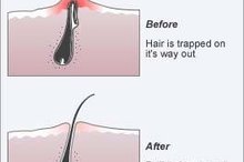 How to Get Rid of an Infected Ingrown Hair