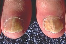 How to Use Bleach for Curing Toenail Fungus