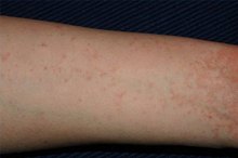 Signs & Symptoms of Human Skin Mites