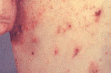 How to Treat Scabies With Tea Tree Oil