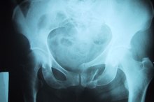 What is a Pelvic Phlebolith?