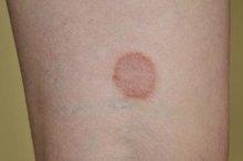 Does Ringworm Go Away on Its Own?