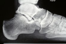 What Is Plantar Calcaneal Enthesophyte?