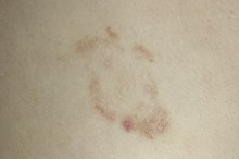 Complications of Ringworm