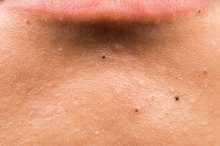 How to Reduce Black Spots on the Face