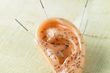 Acupuncture for Clogged Ears