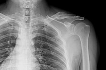 Rehab for a Broken Collarbone After Surgery