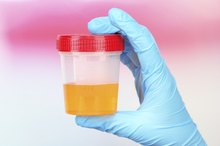 What Causes Orange Urine and Elevated Liver Function Tests?