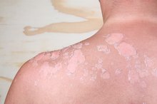 Reasons for Purplish Skin on the Neck Area