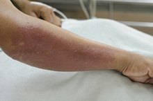 Causes of a Red Rash on My Arm