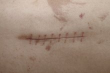 How to Treat Scars After Surgery