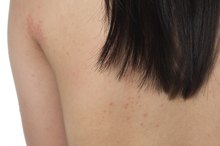 Are Red Spots on the Skin a Gluten Allergy?