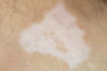 Skin Disorders That Cause Pigment Loss