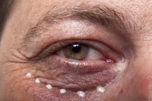 How to Get Rid of Under-Eye Lines & Wrinkles
