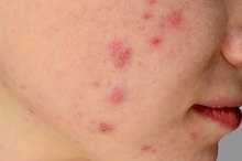 Why Does Pus From Acne Have an Odor?